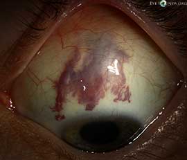 Conjunctival varix