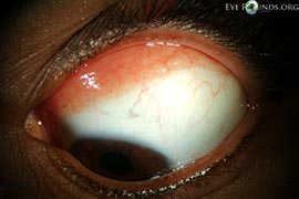 Conjunctival lymphoid hyperplasia