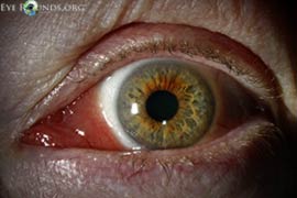 Conjunctival lymphoma