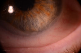 Conjunctiva is sucked up into the bowl of the scleral contact lens resulting in wavy white folds at the peripheral cornea.