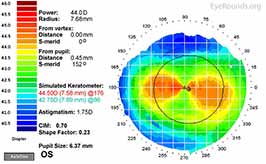 Against-the-rule corneal astigmatism