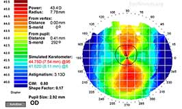 With-the-rule corneal astigmatism