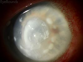 Corneal satellite infiltrates
