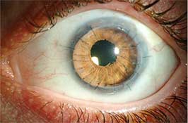 CustomFlex iris prosthesis and penetrating keratoplasty (PKP) for acanthamoeba keratitis