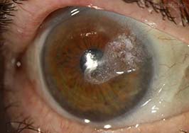 Cyanoacrylate adhesive for corneal perforation secondary to peripheral ulcerative keratitis (PUK)