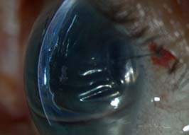 Corneal edema with Descemet's membrane folds after DMEK