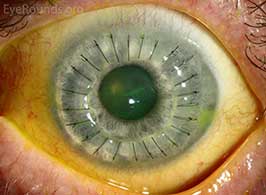 Deep Anterior Lamellar Keratoplasty (DALK)