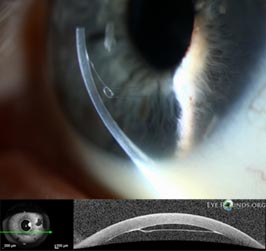 Graft edge lift after Descemet's membrane endothelial keratoplasty (DMEK)