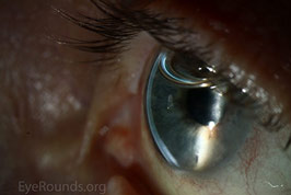 Descemet Membrane Endothelial Keratoplasty (DMEK)