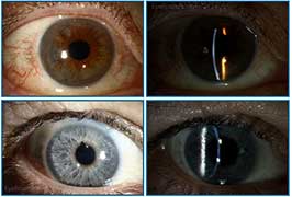 Descemet Stripping Automated Endothelial Keratoplasty (DSAEK)
