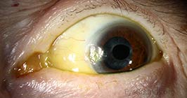 Corneal delle