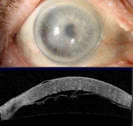 Descemet membrane detachment after cataract extraction
