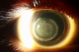 Herpes simplex virus (HSV) disciform keratitis