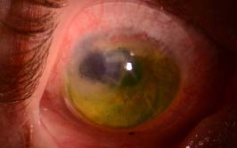 EyePrint Pro® over mini penetrating keratoplasty (PKP)
