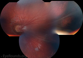 Familial Exudative Vitreoretinopathy (FEVR)