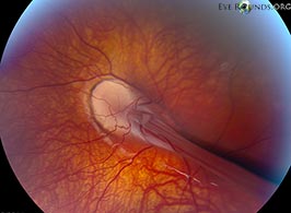 Familial Exudative Vitreoretinopathy (FEVR)