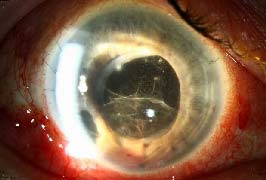 Post-Operative Anterior Chamber Fibrin