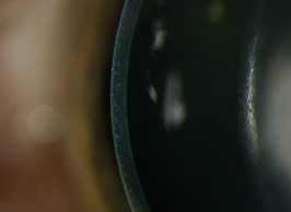 Fleck Corneal Dystrophy