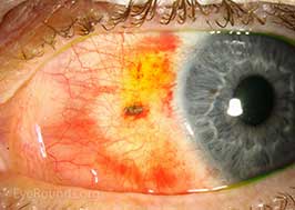 Subconjunctival metallic foreign body