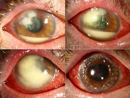 Fungal keratitis