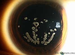 Granular corneal dystrophy