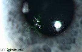 Herpes simplex virus (HSV) epithelial keratitis, dendrite