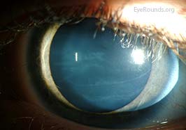 Haab striae