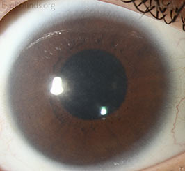 Corneal clouding in Hurler's syndrome