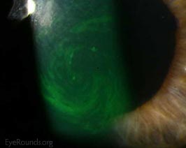 Hurricane Keratopathy