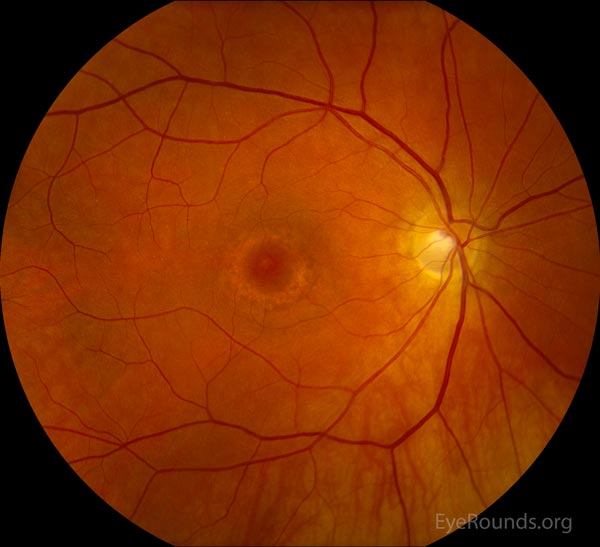 right eye. melanin in the retinal pigmented epithelium (RPE)