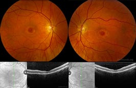 Bull's-eye maculopathy due to hydroxychloroquine toxicity