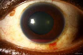 traumatic hyphema