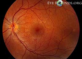 Intraretinal Microvascular Abnormality (IrMA)