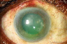 Interstitial Keratitis Secondary to Syphillis