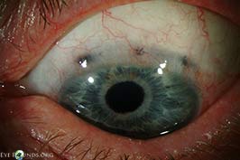 Iris incarceration in an old extracapsular wound