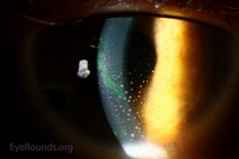 Keratic precipitates (KP) in juvenile idiopathic arthritis (JIA)
