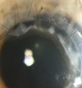 Kaye dots in a penetrating keratoplasty graft