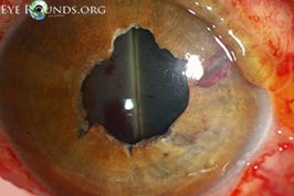 Kissing choroidal