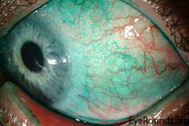Lissamine green staining in keratoconjunctivitis sicca