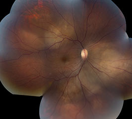 Langerhans histiocytosis with choroidal infiltrates
