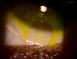 Lens Fluting