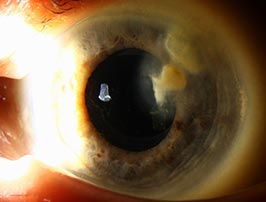 Lipid keratopathy