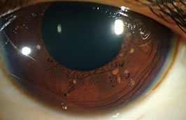 Lisch nodules