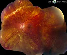 Multifocal choroiditis and panuveitis (MCP )