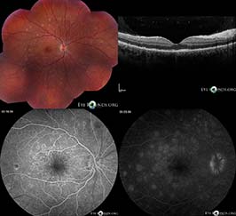 Multiple evanescent white dot syndrome (MEWDS)
