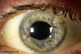 Suture iris reconstruction using McCannel suture technique