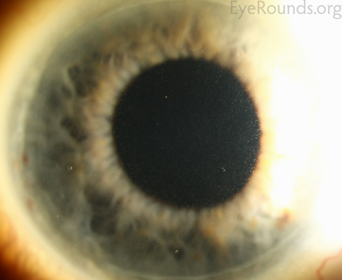 Meesmann epithelial corneal dystrophy high mag alternative
