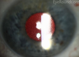 Meesman epithelial corneal dystrophy