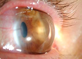 Megalocornea