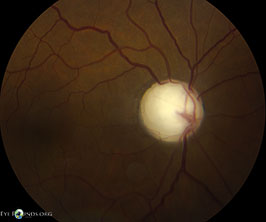Megalopapillae with severe glaucoma